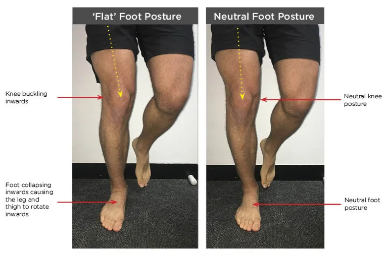 foot posture and knee pain