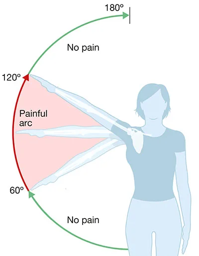 Shoulder Bursitis: A painful arc