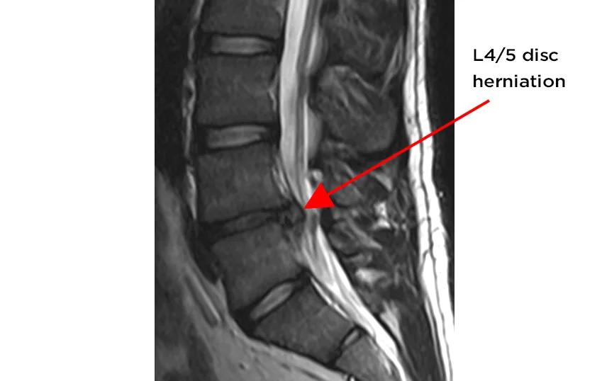 An MRI scan of a disc herniation