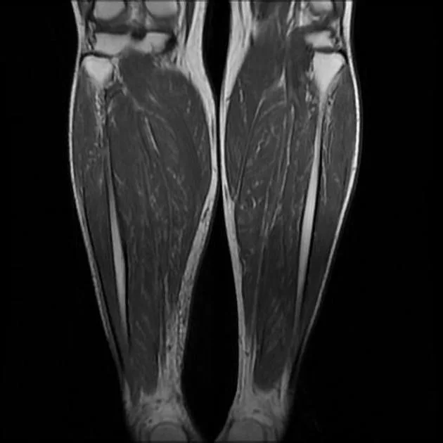 Calf MRI